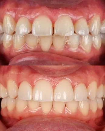 veneers on top teeth