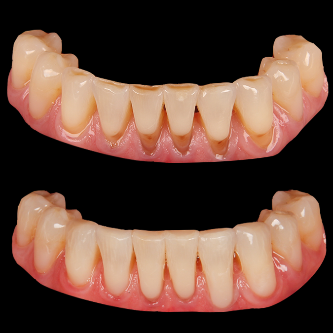 Dental bonding before and after