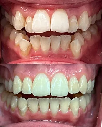 Before/after comparison showing full mouth dental restoration - upper and lower teeth transformed from discolored, damaged teeth to restored smile with crowns and veneers