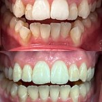 Before/after comparison showing full mouth dental restoration - upper and lower teeth transformed from discolored, damaged teeth to restored smile with crowns and veneers
