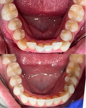 Before/after occlusal view of lower dental arch showing transformation from decayed and missing teeth to complete arch restoration
