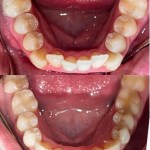 Before/after occlusal view of lower dental arch showing transformation from decayed and missing teeth to complete arch restoration