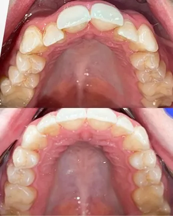 Before/after upper palate view demonstrating full arch dental reconstruction from compromised teeth to restored dental arch