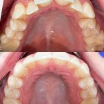 Before/after upper palate view demonstrating full arch dental reconstruction from compromised teeth to restored dental arch