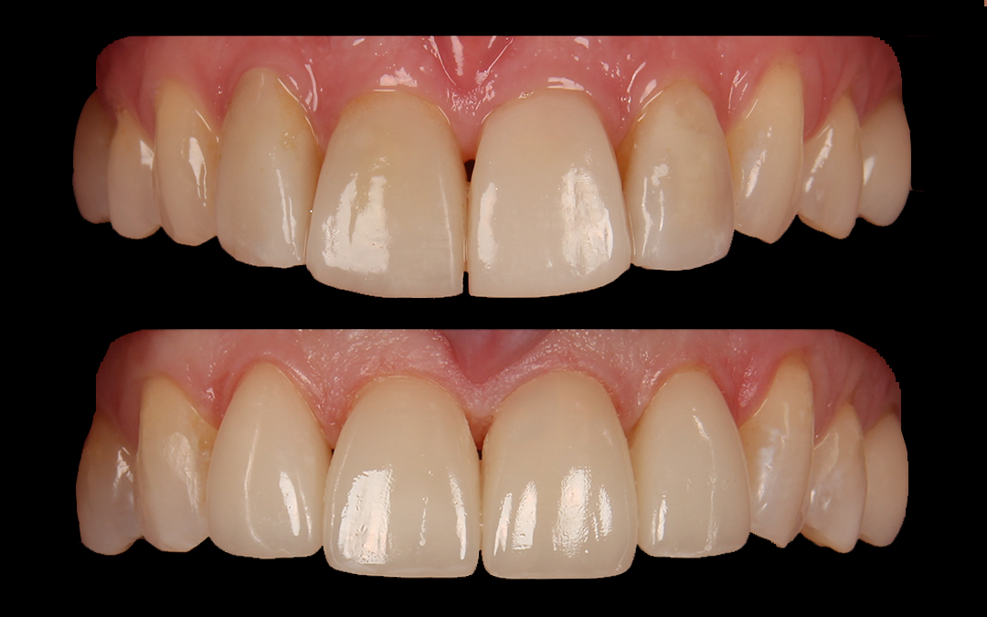 Before and after dental veneers