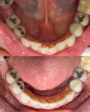 Before/after lower arch showing progression from teeth with metal framework to completed dental restoration with crowns or bridges