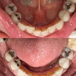 Before/after lower arch showing progression from teeth with metal framework to completed dental restoration with crowns or bridges