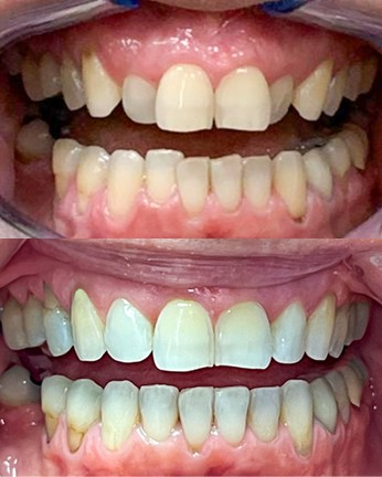 Before/after lateral view of full mouth rehabilitation showing correction of spacing and alignment issues with comprehensive dental work