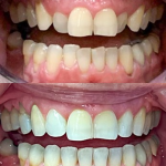 Before/after lateral view of full mouth rehabilitation showing correction of spacing and alignment issues with comprehensive dental work