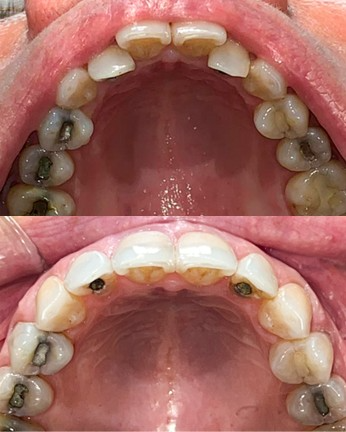 Before/after occlusal view of dental arch restoration showing transformation from decayed teeth to reconstructed dental arch with prosthetics