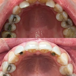 Before/after occlusal view of dental arch restoration showing transformation from decayed teeth to reconstructed dental arch with prosthetics