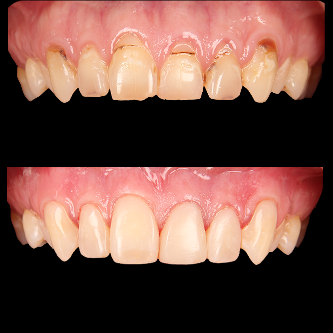 Before and after dental restoration showing upper front teeth transformation from decayed and discolored teeth to restored, whiter smile with dental crowns or veneers