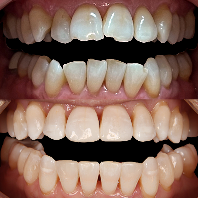 Before and after bite correction showing transformation from open bite with spacing to proper occlusion with restored teeth and crowns