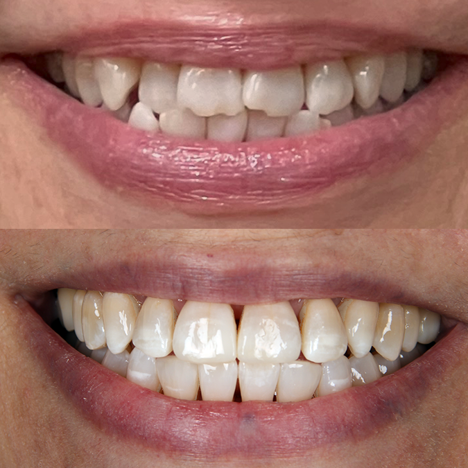 Before and after smile makeover showing correction of gaps between front teeth and improved alignment with dental veneers or bonding